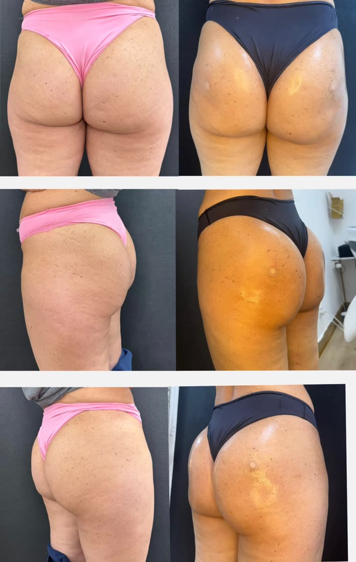 Glúteos antes e depois, em três ângulos