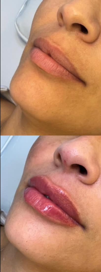 Preenchimento labial antes e depois