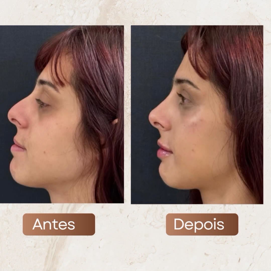 Rinomodelação: nariz de perfil antes e depois