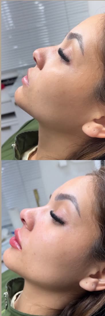 Perfiloplastia: nariz, lábios e queixo antes e depois