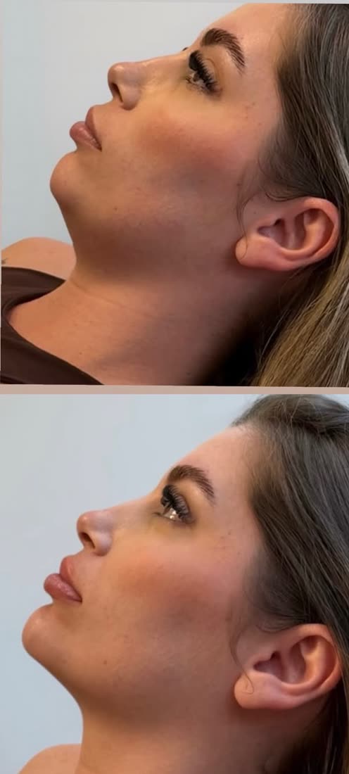 Perfiloplastia: perfil antes e depois
