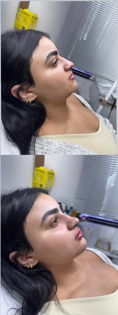 Rinomodelação e perfil antes e depois