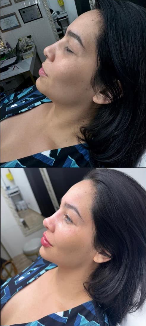 Harmonização de perfil antes e depois