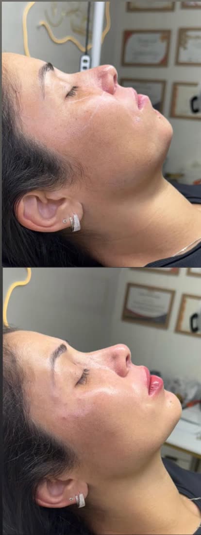 Perfil e lábios antes e depois