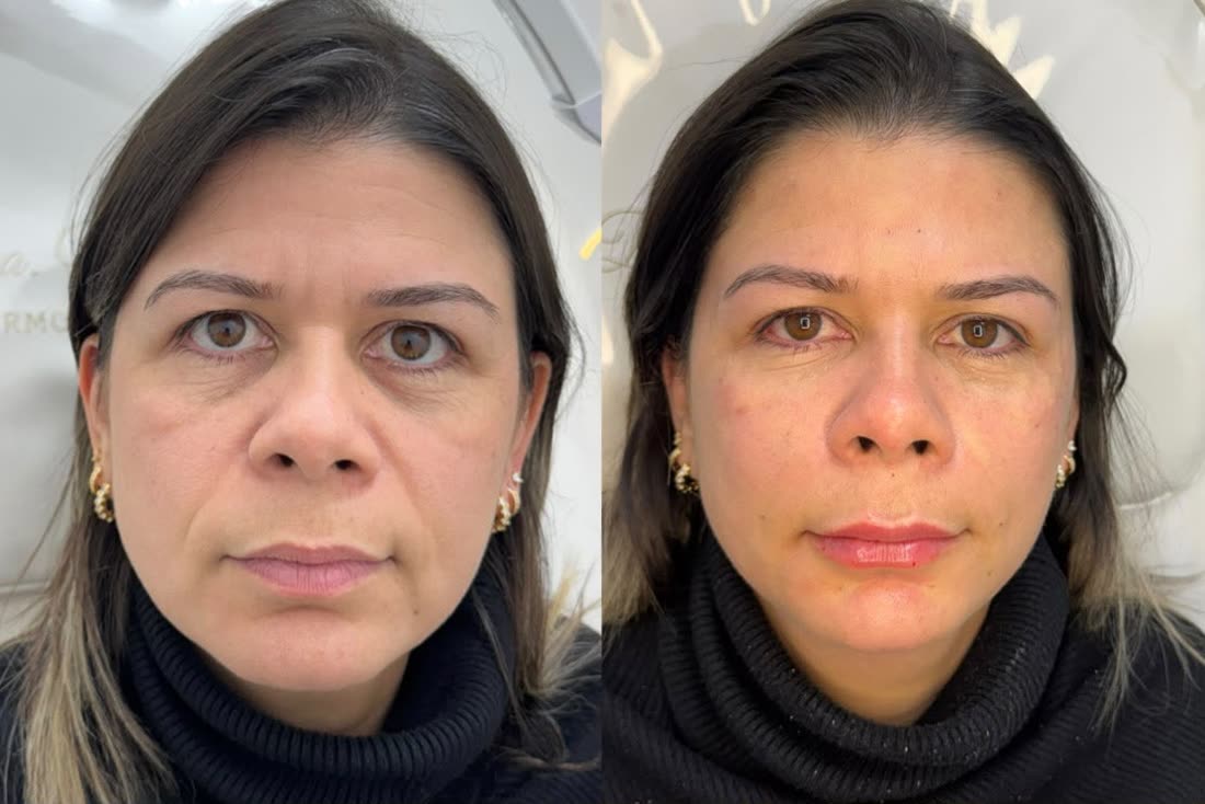 Rejuvenescimento facial: rosto de frente antes e depois