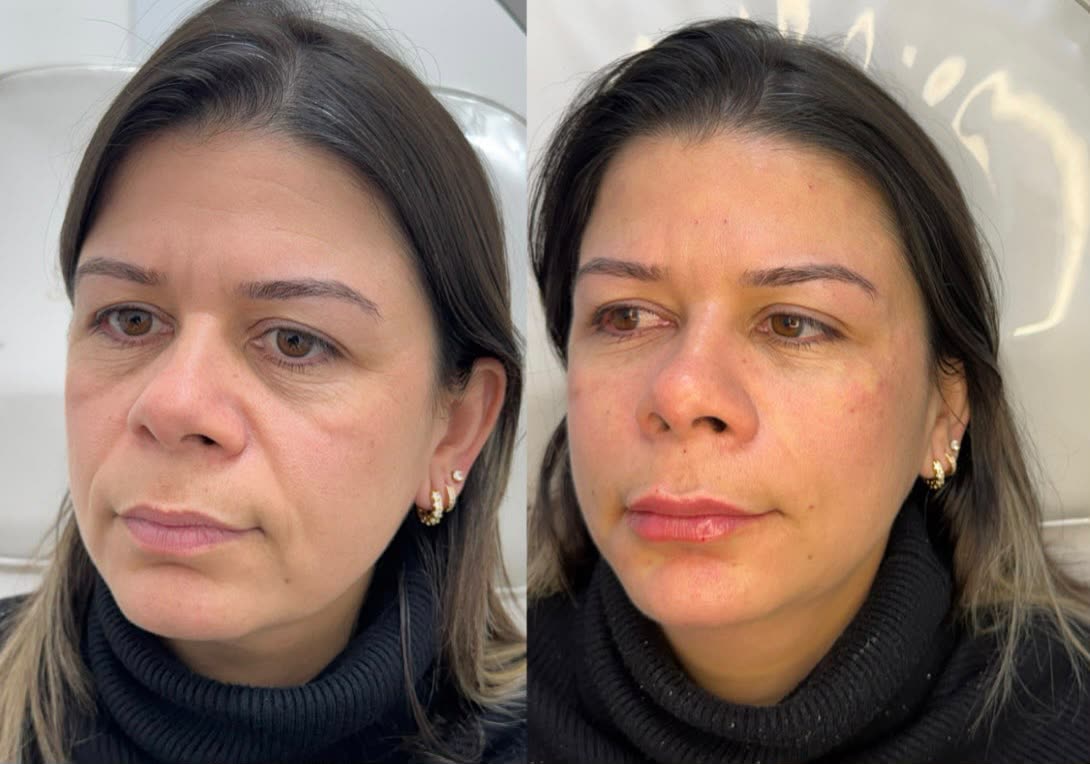 Rejuvenescimento facial: rosto de três quartos antes e depois