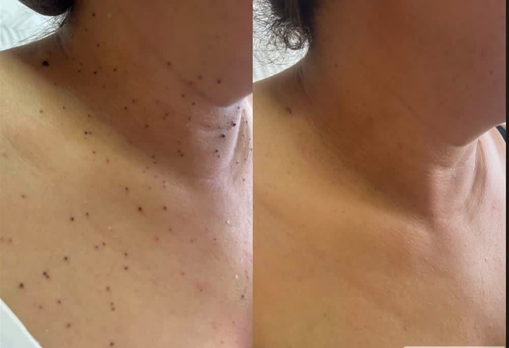 Acrocórdons no pescoço antes e depois da remoção