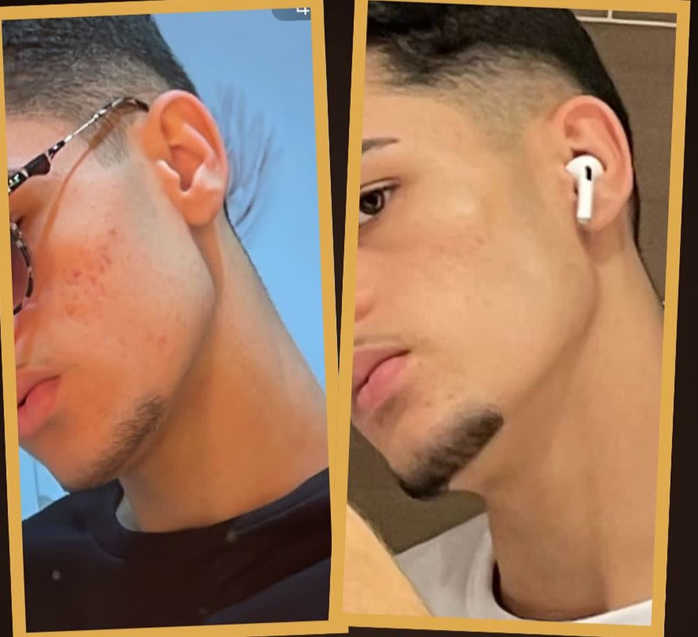 Antes e depois de tratamento de acne