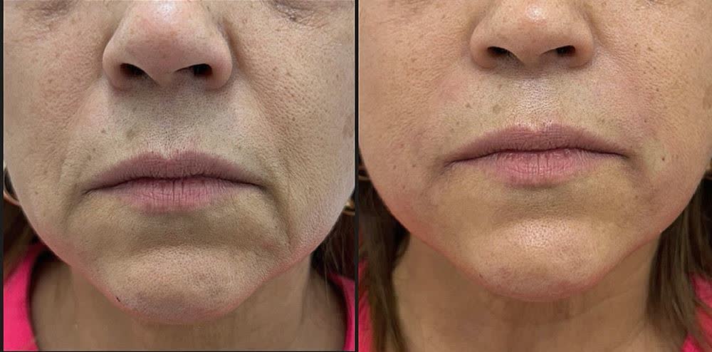 Antes e depois de preenchimento do bigode chinês