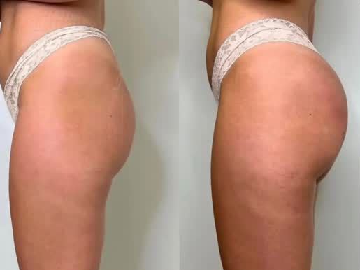 Antes e depois de bumbum glow