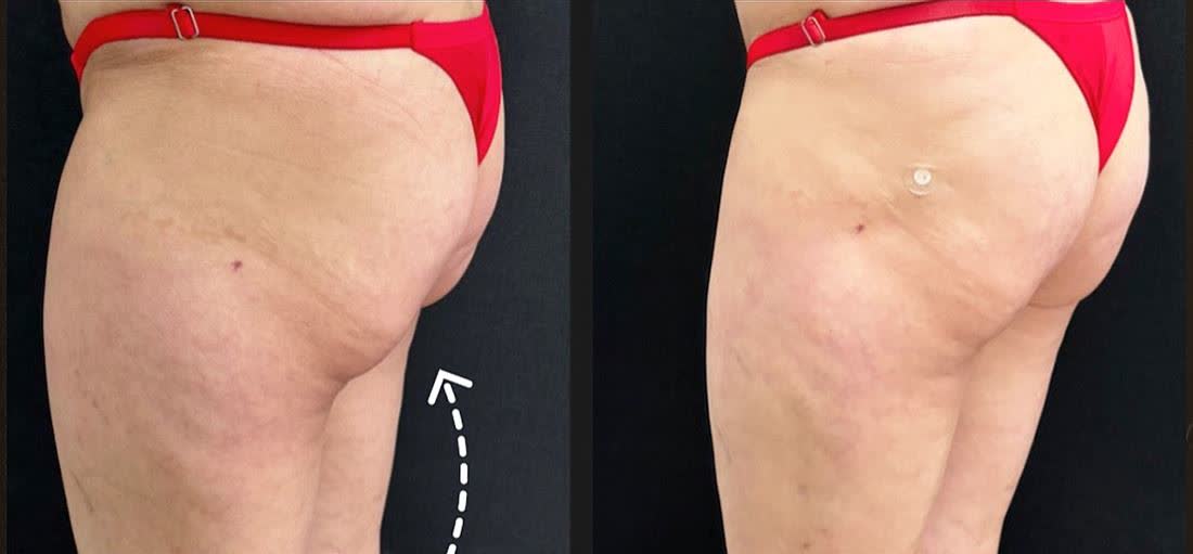 Antes e depois de preenchimento glúteo