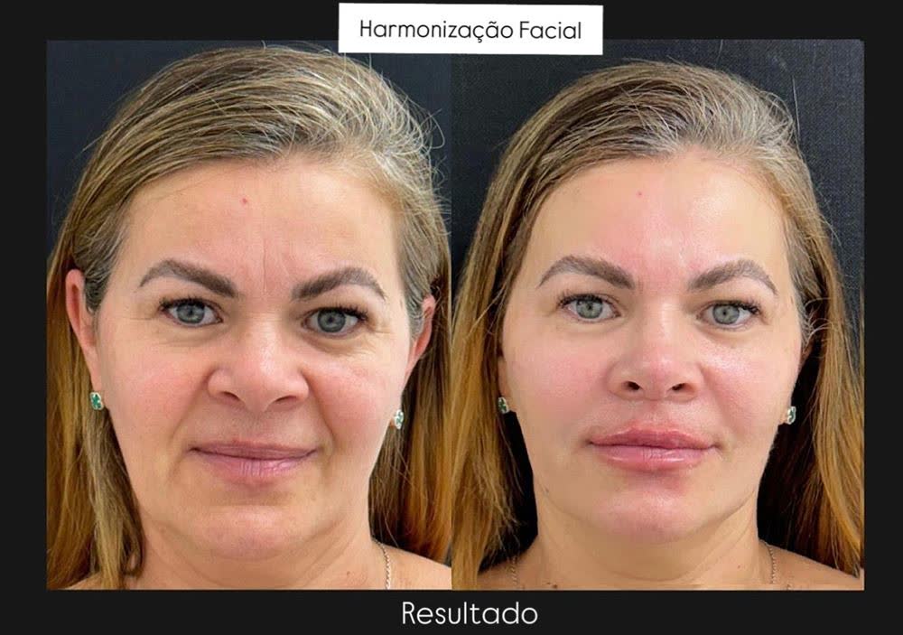 Antes e depois de harmonização facial, vista frontal