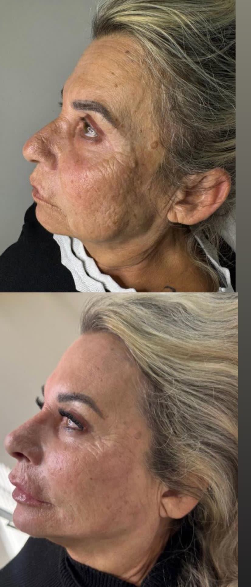 Rejuvenescimento facial com bioestimulador