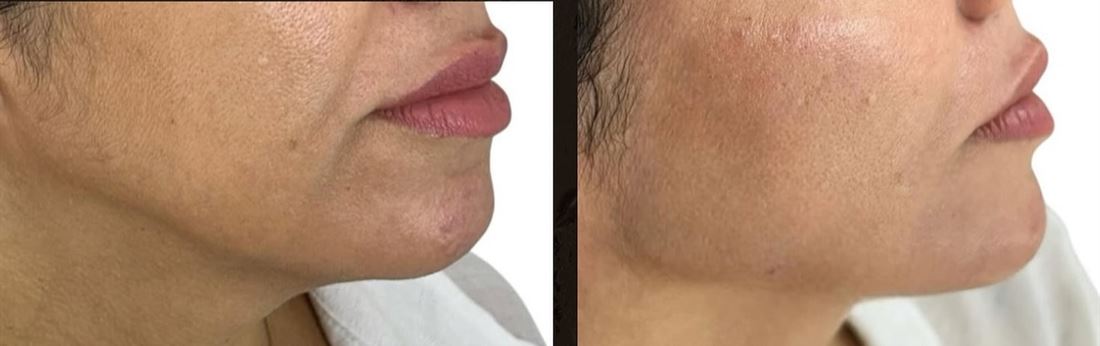 Antes e depois de preenchimento de mandíbula