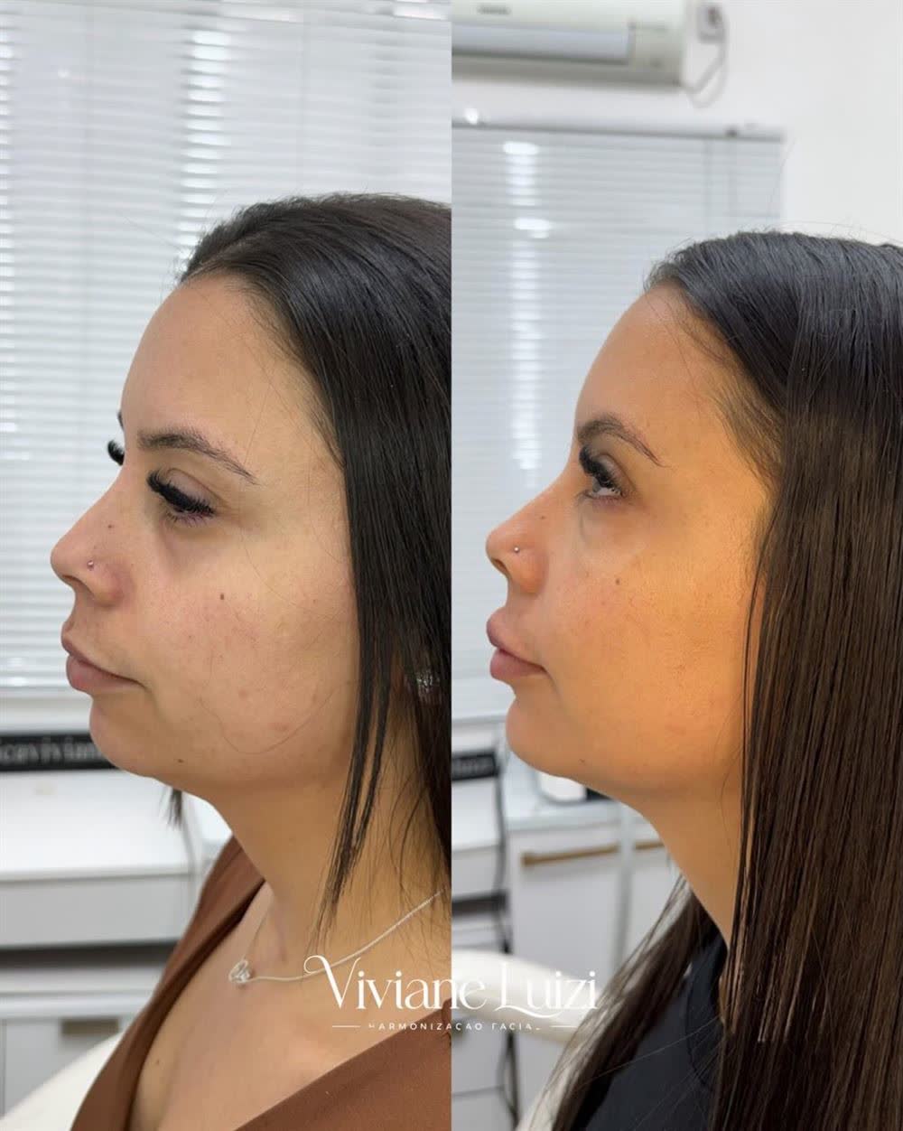 Antes e depois de perfiloplastia, vista lateral