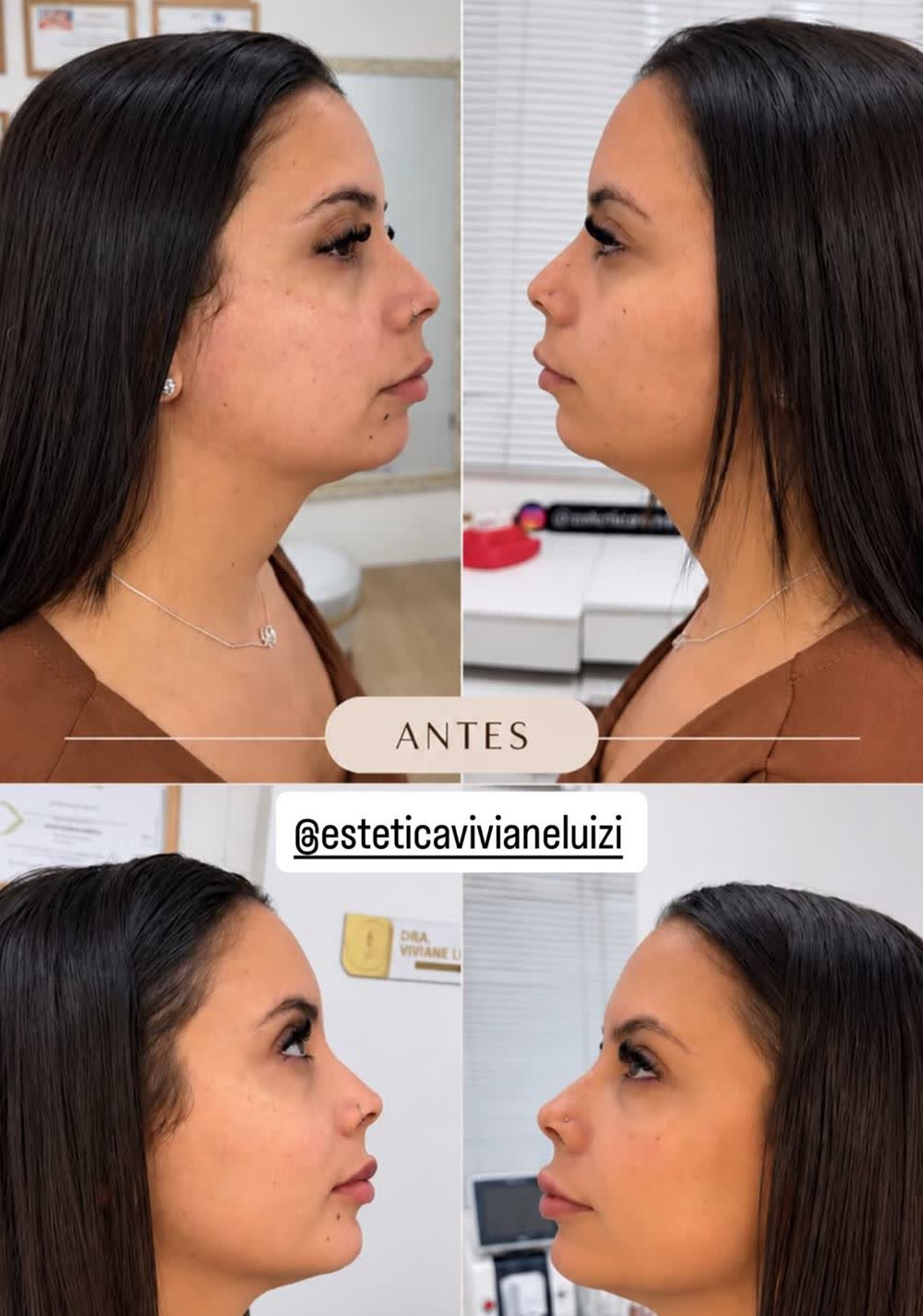 Antes e depois de perfiloplastia em outra paciente