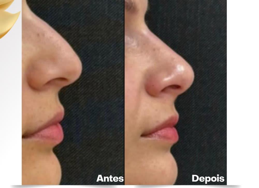 Antes e depois de rinomodelação