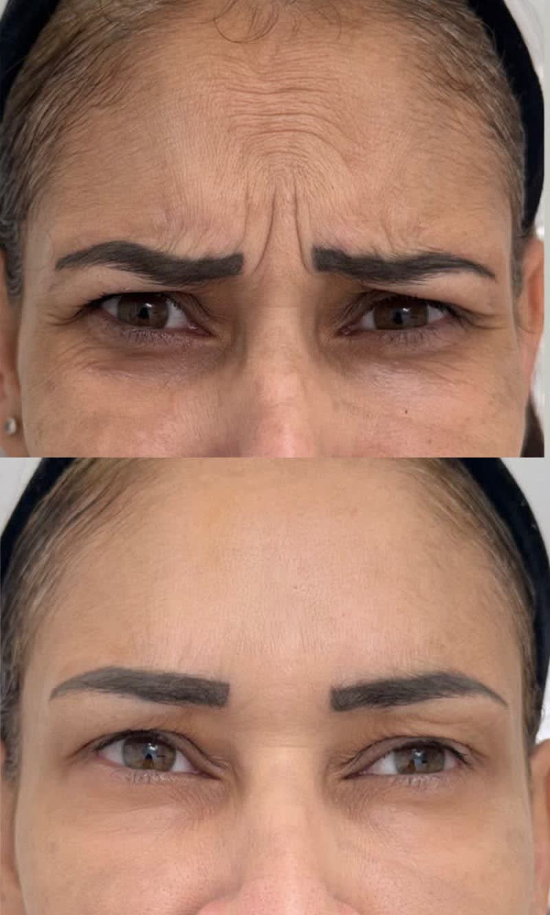 Testa e glabela franzidas antes e relaxadas depois da toxina botulínica