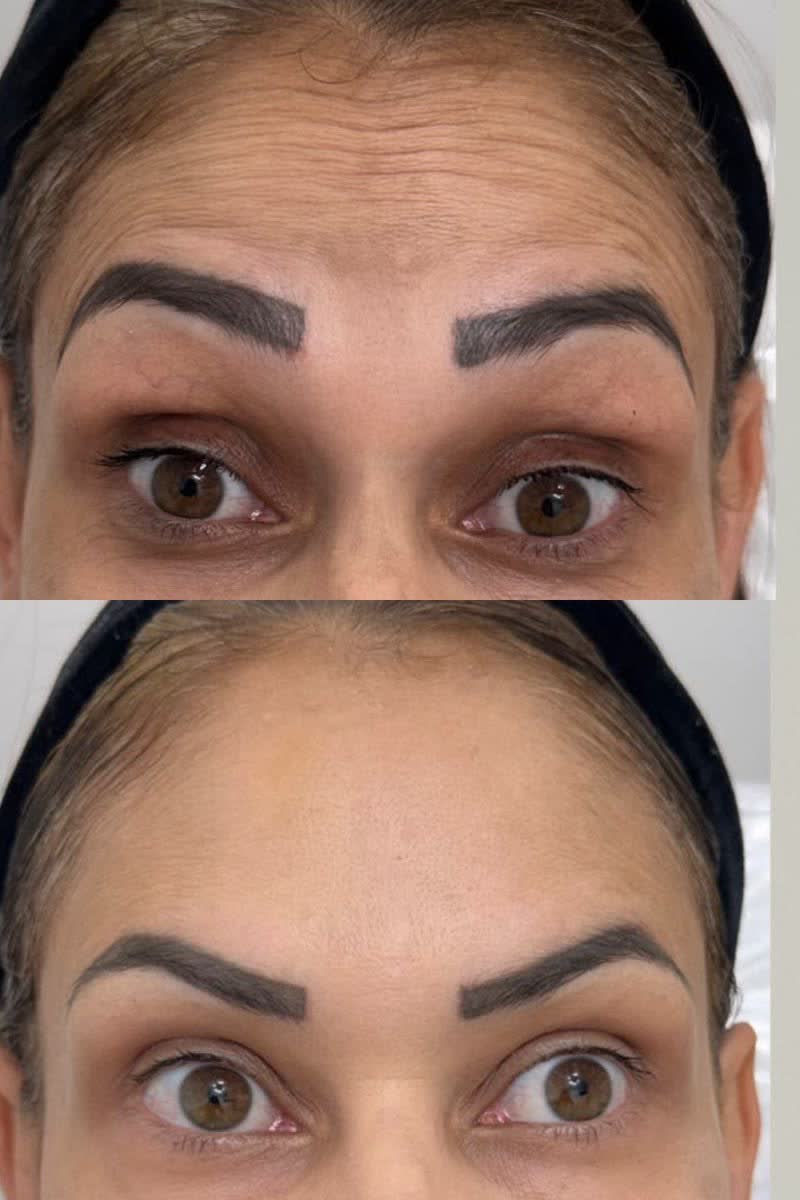Linhas da testa antes e depois da toxina botulínica em outra paciente