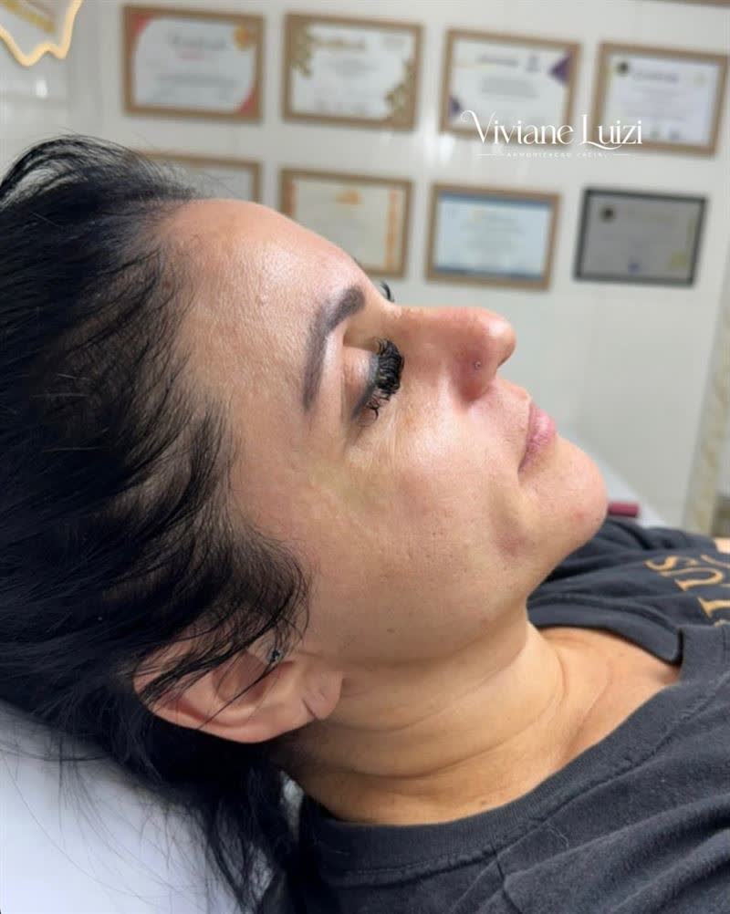 Paciente em procedimento de perfiloplastia