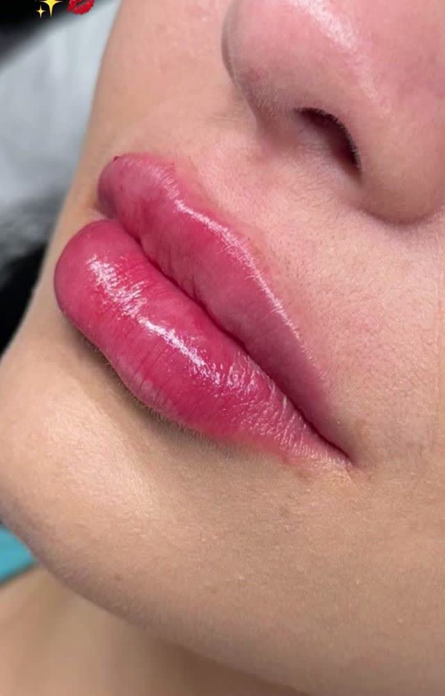 Lábios após preenchimento labial